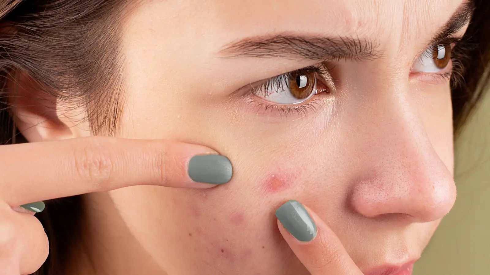 The Acne-Fighting Mechanism of Honey Most Guides Miss